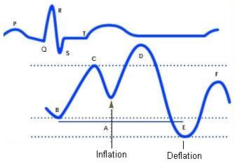 Diagram of correct intra aortic balloon timing; A= One complete cardiac cycle, B= Unassisted aortic end diastolic pressure, C= Unassisted systolic blood pressure, D= Diastolic augmentation, E= Reduced aortic end diastolic pressure, F= Reduced systolic blood pressure