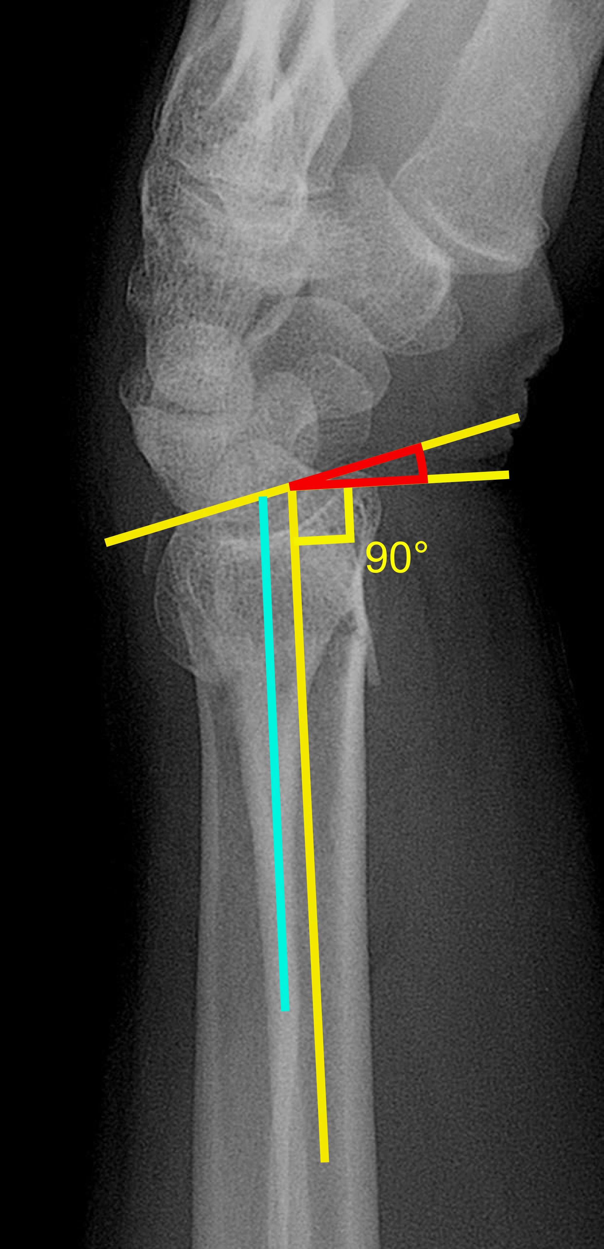 File:Dorsal tilt of distal radius fracture.jpg
