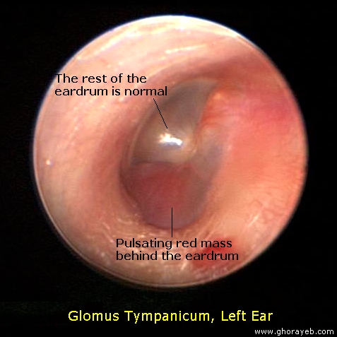 Picture of a left tympanic membrane with a pulsating red mass occupying the inferior portion of the middle ear space. The rest of the tympanic membrane is normal[1].