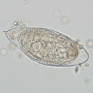 Egg of S. haematobium in a wet mount of a urine concentrate. Adapted from CDC