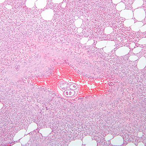 Angiostrongylus costaricensis female worm in appendix tissue sections stained with hematoxylin and eosin (H&E). Image courtesy of Regions Hospital, St. Paul, MN. Adapted from CDC