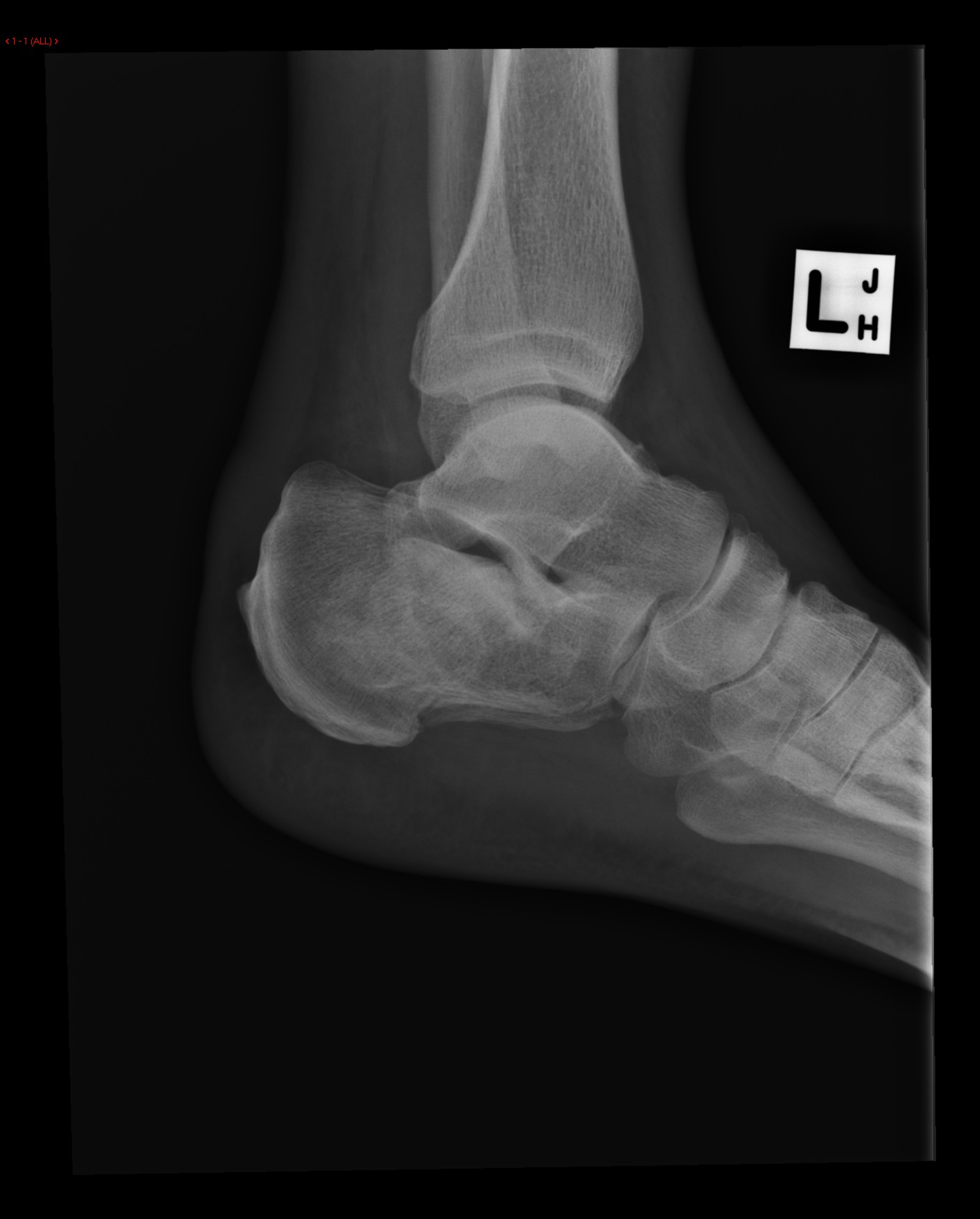 File:Calcaneal-fracture-and-associated-spinal-injury (2).jpg