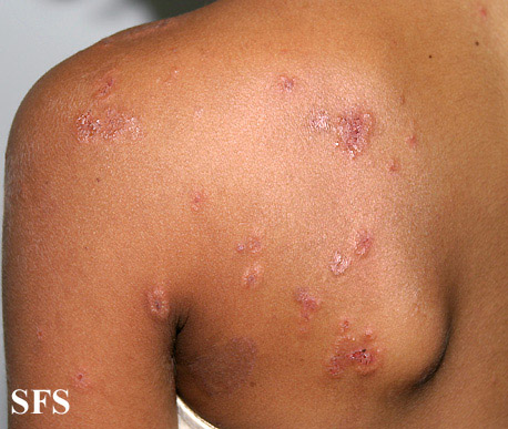 File:Dermatitis herpetiformis26.jpg