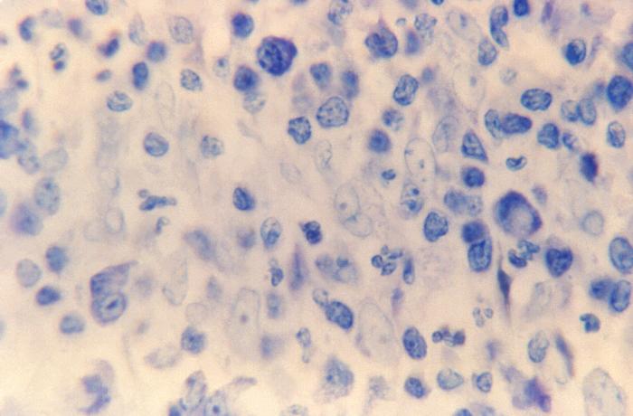 “Donovan bodies” in a tissue sample used to diagnose granuloma inguinale. From Public Health Image Library (PHIL). [5]
