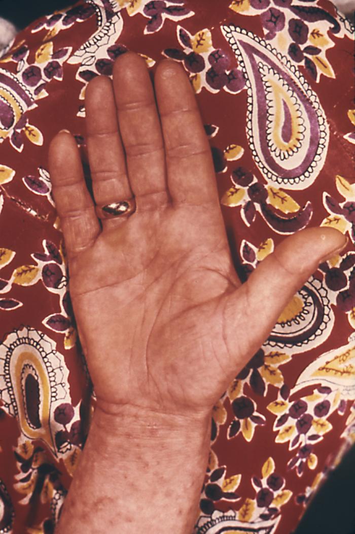 This patient presented with a secondary syphilitic maculopapular rash of the right hand and forearm. The second stage starts when one or more areas of the skin break into a rash that appears as rough, red or reddish brown spots both on the palms of the hands and on the bottoms of the feet. Even without treatment, rashes clear up on their own. Adapted from CDC