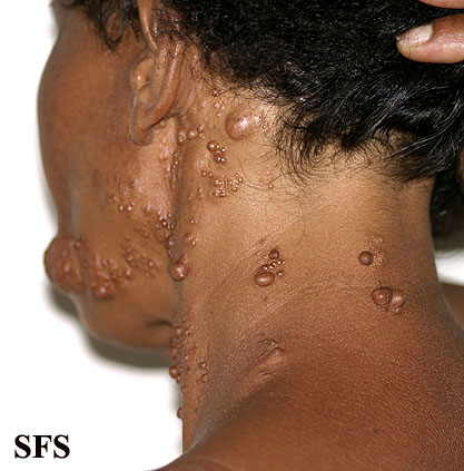 Segmental neurofibromatosis. Adapted from Dermatology Atlas.[3]