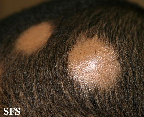 File:Alopecia areata 18.jpeg