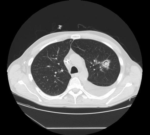 Chest CT scan demonstrating a well rounded mass located inside a lung cavity, and surrounded by a crescent of air