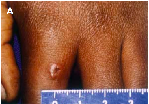 File:Cutaneous A1.png