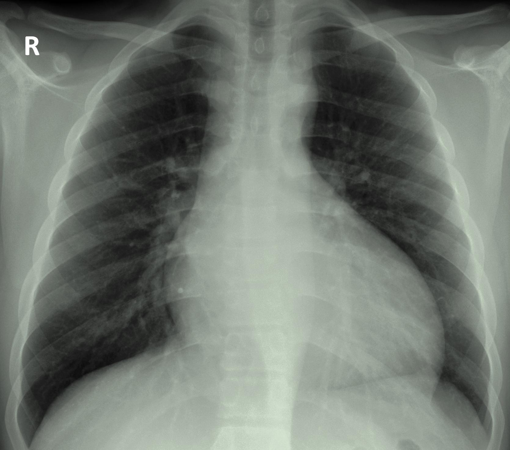 File:Aortic regurgitation x-ray.jpg