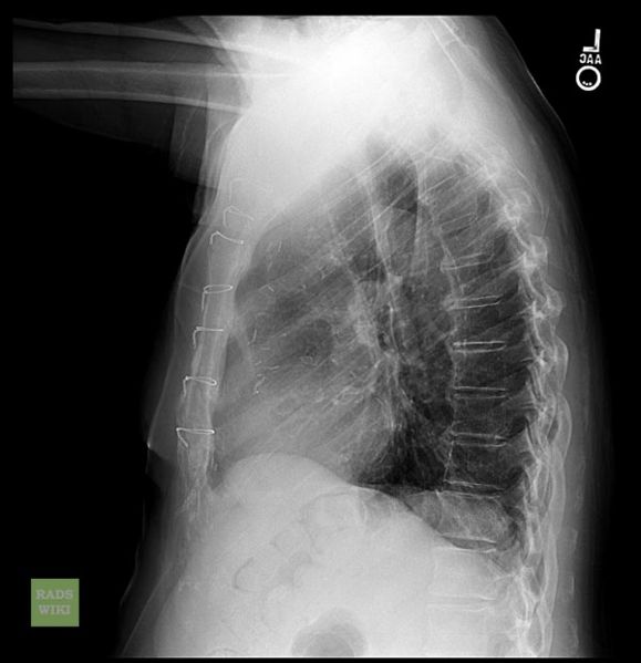 File:Diaphragmatic eventration 003.jpg