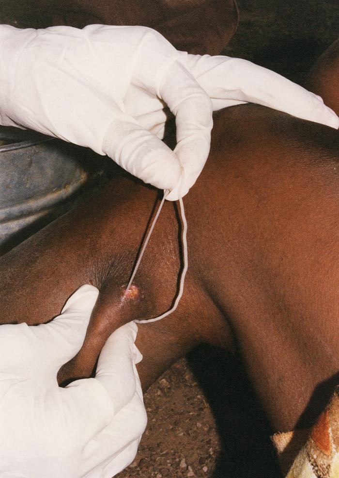 This image depicts the subcutaneous emergence of a female Guinea worm, Dracunculus medinensis, from a sufferer’s lower left leg. From Public Health Image Library (PHIL). [8]