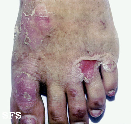 Epidermolysis bullosa simplex. Adapted from Dermatology Atlas.[6]