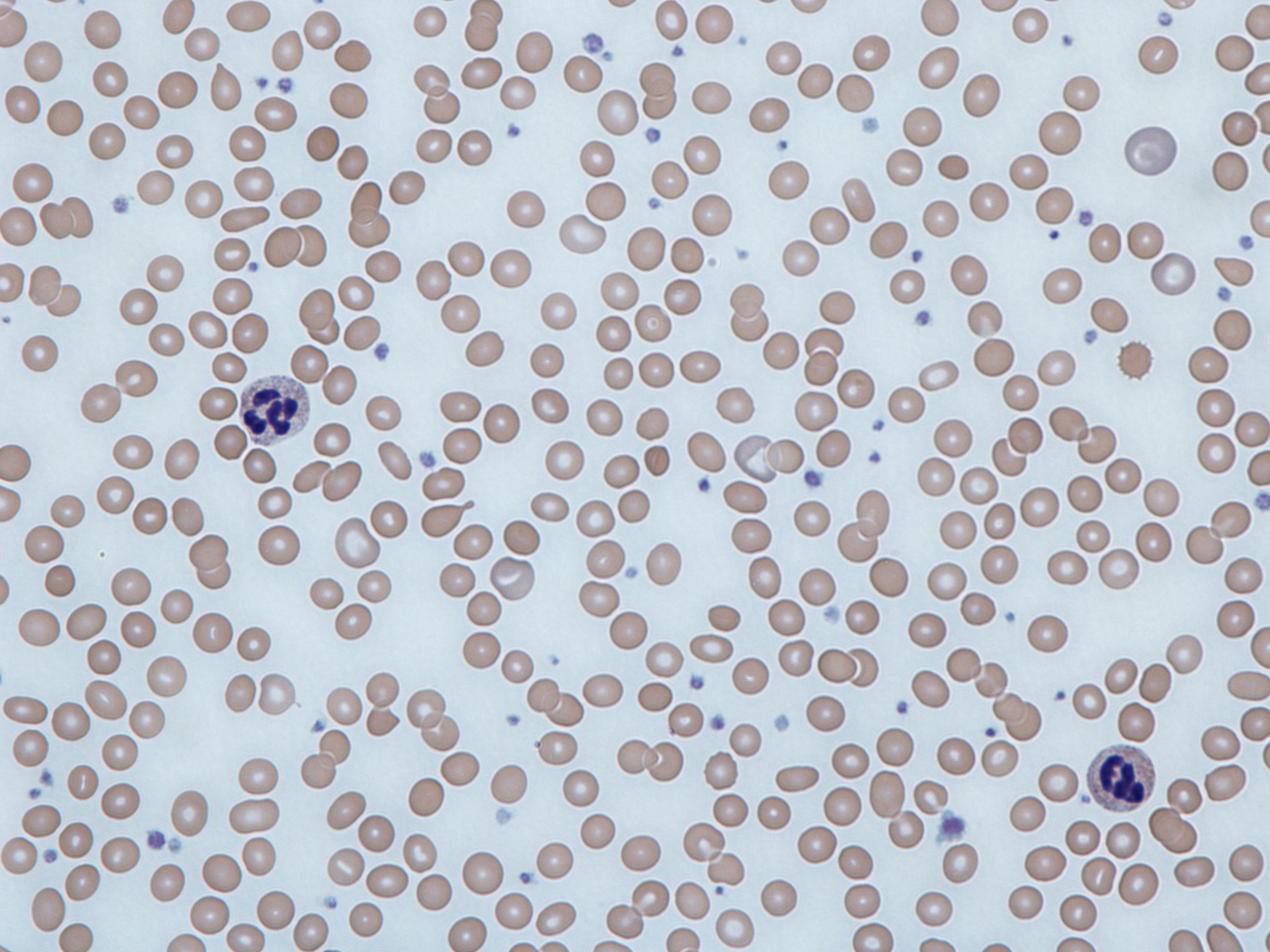 File:Iron deficiency anemia blood film.jpg