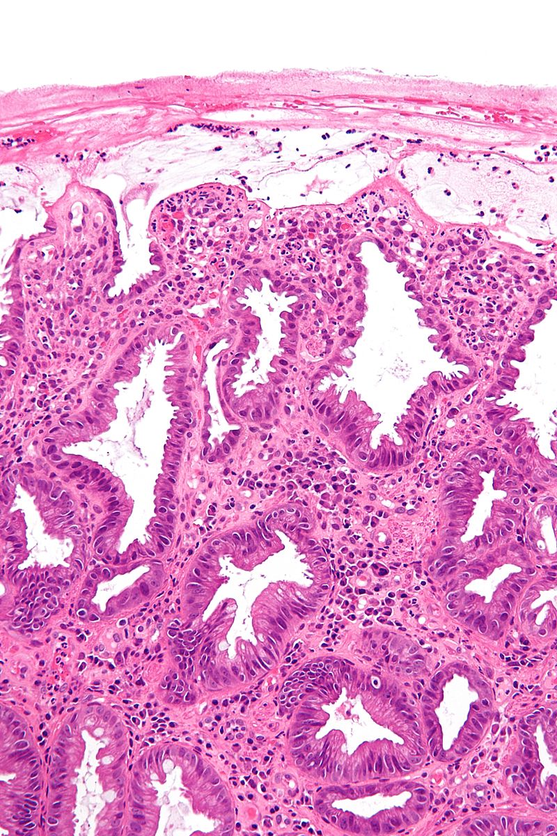 Ischemic colitis. H&E staining showing changes seen in ischemic colitis [47]