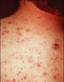Acne frequently occurs on the back. Here, there are 2 to 6 millimeter wide erythematous (red) pustules with large open and closed comedones. Permanent scarring may follow a severe case of acne. Men are more often affected on their shoulders and back than are women.