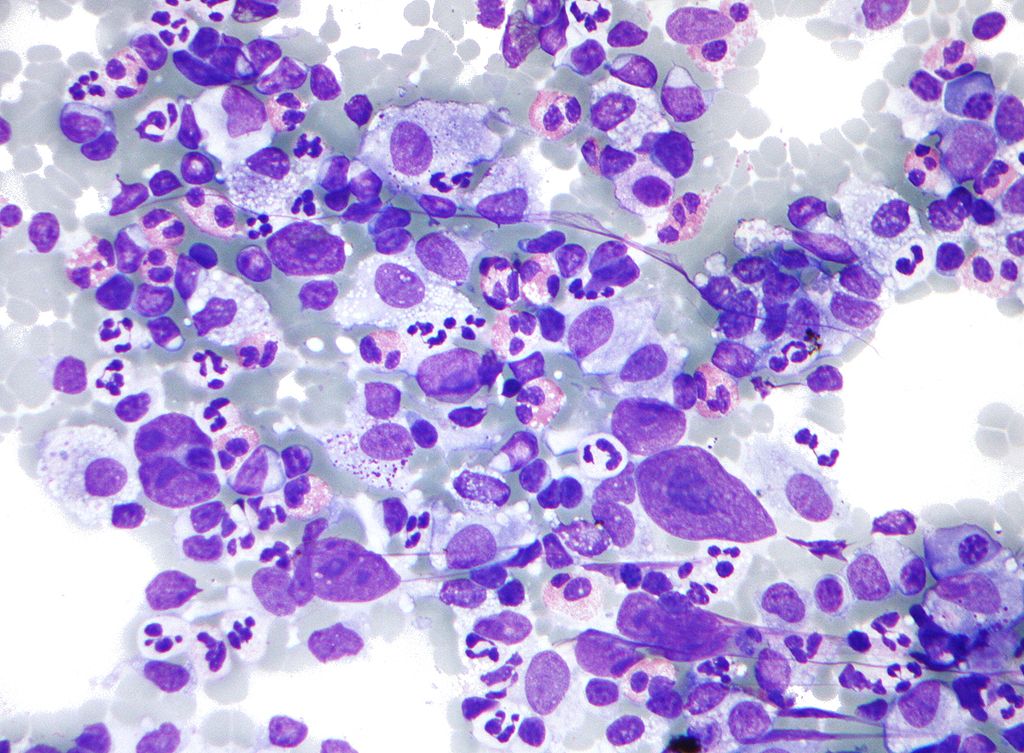 Micrograph of Hodgkin lymphoma, abbreviated HL. Lymph node FNA specimen. Field stain. The micrograph shows a mixture of cells common in Hodgkin's lymphoma: eosinophils, Reed-Sternberg cells, plasma cells, and histocytes.