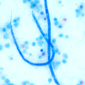 Higher magnification of the microfilariae in Figure 7, taken at 500x oil magnification. Adapted from CDC