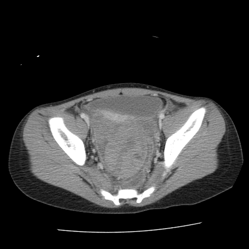 8 y/o female with right lower quadrant pain patient#2