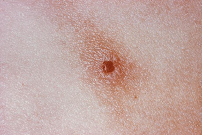 This is a skin lesion in a patient with systemically disseminated Neisseria gonorrhoeae bacteria. Gonorrhea, caused by Neisseria gonorrhoeae, if left untreated will enter the blood, thereby, spreading throughout the body. As is shown here, such fully systemic dissemination may manifest itself as skin lesions throughout the body. Adapted from CDC