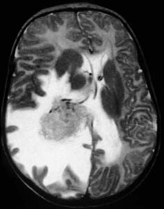 Choroid plexus papilloma: T2 weighted axial MRI shows intense surrounding vasogenic edema. CPPs typically enhance dramatically following contrast administration on CT or MRI. Parenchymal invasion with edema may occur. Imaging findings are not reliable for distinguishing between CPP and choroid plexus carcinoma, which represent about 10% of choroid plexus neoplasms.