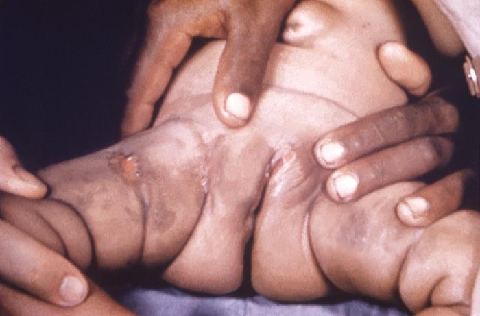 This image depicts the perineal region and upper thighs of an infant born with what was diagnosed as congenital syphilis. In this particular case, one will note the presence of early cutaneous syphilids. How does syphilis affect a pregnant woman and her baby: The syphilis bacterium can infect the baby of a woman during her pregnancy. Depending on how long a pregnant woman has been infected, she may have a high risk of having a stillbirth (a baby born dead) or of giving birth to a baby who dies shortly after birth. An infected baby may be born without signs or symptoms of disease. However, if not treated immediately, the baby may develop serious problems within a few weeks. Untreated babies may become developmentally delayed, have seizures, or die. Infants born to mothers who have reactive nontreponemal and treponemal test results should be evaluated with a quantitative nontreponemal serologic test (RPR or VDRL) performed on infant serum because umbilical cord blood can become contaminated with maternal blood and could yield a false-positive result. Conducting a treponemal test (i.e., TP-PA or FTA-ABS) on a newborn’s serum is not necessary. No commercially available immunoglobulin (IgM) test can be recommended. All infants born to women who have reactive serologic tests for syphilis should be examined thoroughly for evidence of congenital syphilis (e.g., nonimmune hydrops, jaundice, hepatosplenomegaly, rhinitis, skin rash, and/or pseudoparalysis of an extremity). Pathologic examination of the umbilical cord by using specific fluorescent antitreponemal antibody staining is suggested. Darkfield microscopic examination or DFA staining of suspicious lesions or body fluids (e.g., nasal discharge) also should be performed. Adapted from CDC