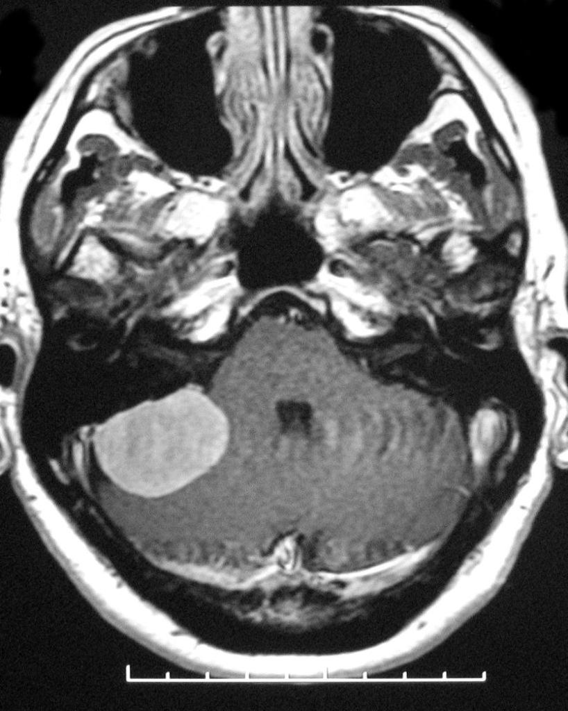 File:Cerebellopontine-angle-meningioma-5.jpg