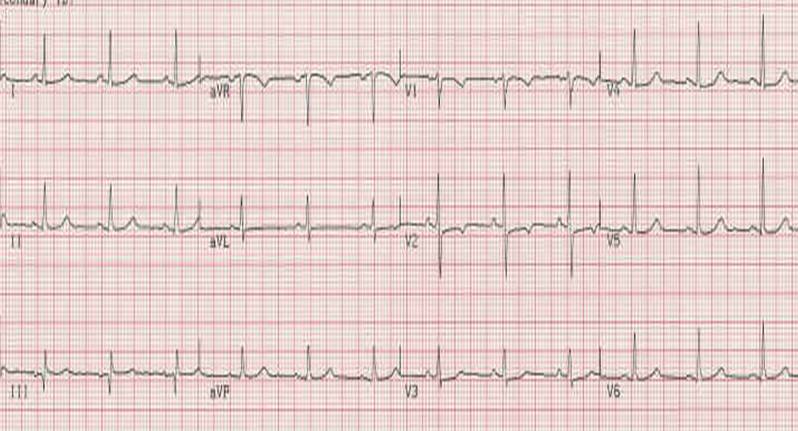 File:Normal EKG.jpg