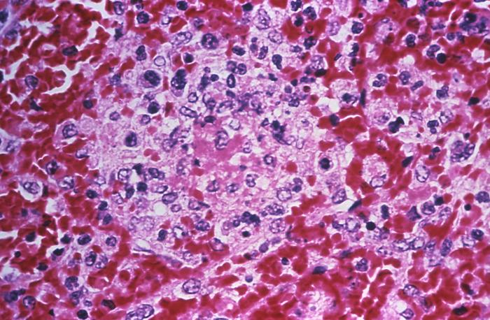 Photomicrograph depicting the histopathologic changes in splenic tissue in a case of fatal human plague; Mag. 400X Adapted from Public Health Image Library (PHIL), Centers for Disease Control and Prevention.[15]