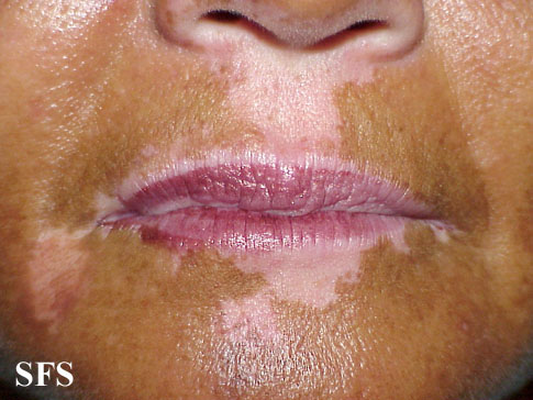Vitiligo. Adapted from Dermatology Atlas[4]