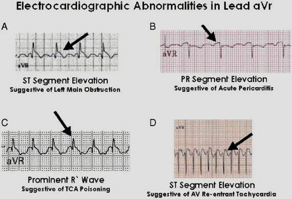 aVr lead abnormalities and differentials.