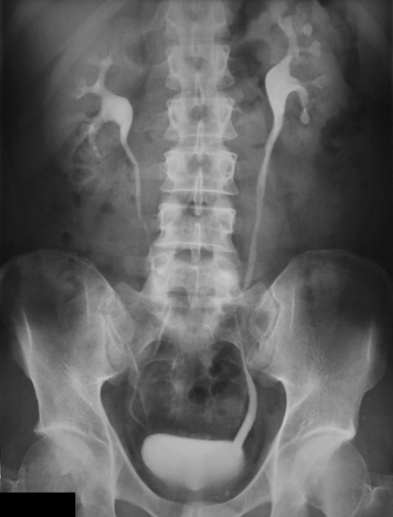 example of an IVU radiograph