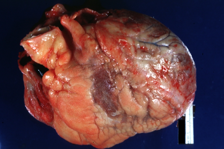 Fibrinous pericarditis: Gross, natural color, anterior view of heart with mild fibrinous exudate over epicardium due to terminal renal failure.