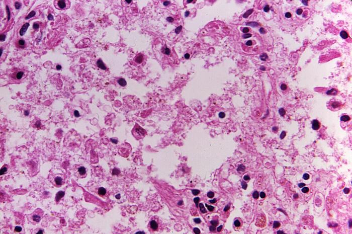Magnification of 500X, this hematoxylin and eosin-stained (H&E) lung tissue sample revealing the histopathologic changes indicative of what was diagnosed as a case of fatal human plague from the country of Nepal. Adapted from Public Health Image Library (PHIL), Centers for Disease Control and Prevention.[15]