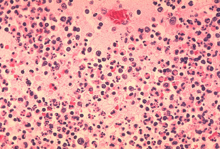 Histopathology of lymph node in fatal human plague Adapted from Public Health Image Library (PHIL), Centers for Disease Control and Prevention.[15]