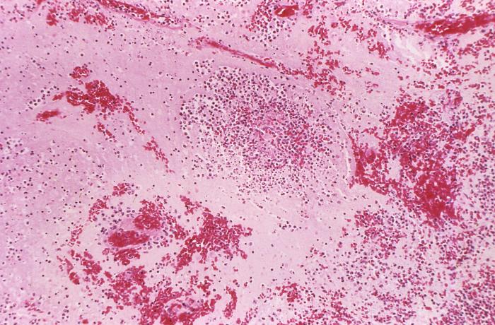 Low magnification of 96X, this hematoxylin-eosin stained (H&E) photomicrograph revealing some of the histopathologic changes seen in a lymph node tissue sample in a case of fatal human plague. Note the medullary necrosis accompanied by fluid due to the presence of Yersinia pestis bacteria Adapted from Public Health Image Library (PHIL), Centers for Disease Control and Prevention.[15]