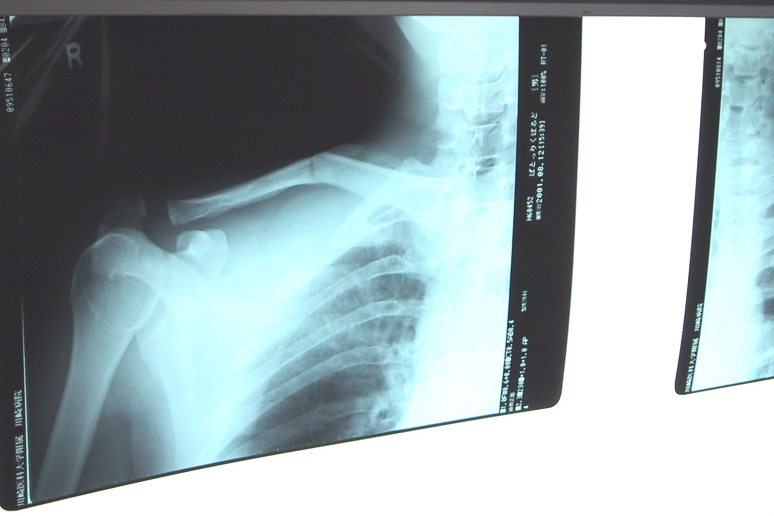 File:Clavicle fracture.jpg