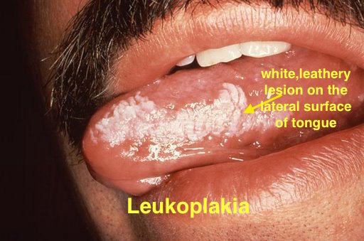 File:Oral hairy leukoplakia (EBV, in HIV)a.jpg