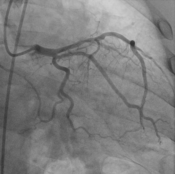 Figure 4. Final angiographic result after thrombectomy and balloon angioplasty.