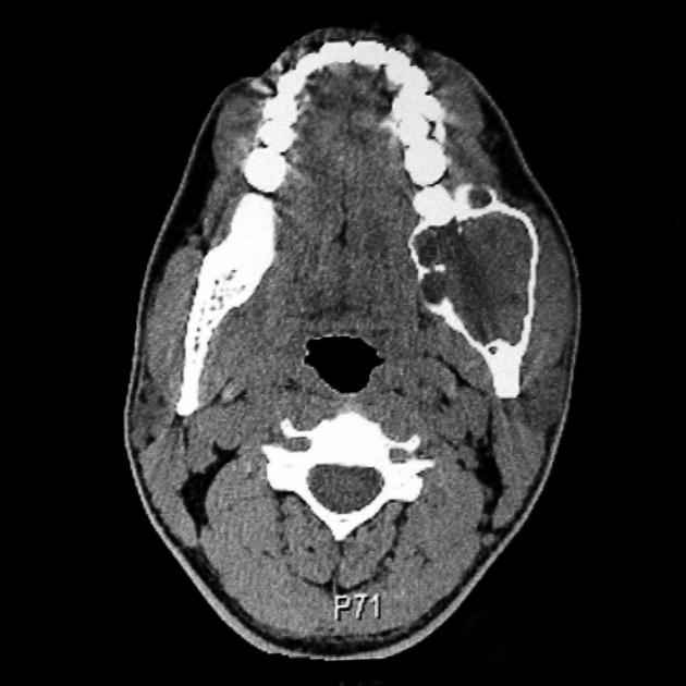 Ameloblastoma CT