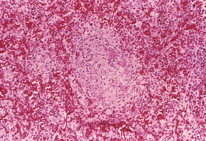At a relatively-low magnification of 160X, this hematoxylin and eosin-stained splenic tissue sample revealed the histopathologic changes indicative of vasculitis and thrombosis associated with what was diagnosed as a case of fatal human plague Adapted from Public Health Image Library (PHIL), Centers for Disease Control and Prevention.[18]