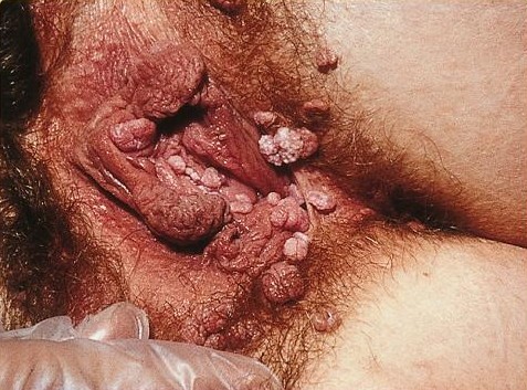 Genital warts on a female