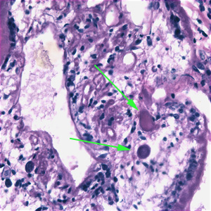 Higher magnification of the sparganum in Figure 3. In this image, calcareous corpuscles (green arrows) can be seen. Adapted from CDC