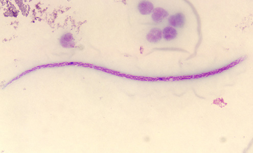 Microfilaria of M. perstans in a thick blood smear stained with Giemsa. Image courtesy of the Parasitology Department, Public Health Lab, Ontario Agency for Health Protection and Promotion, Canada. Adapted from CDC