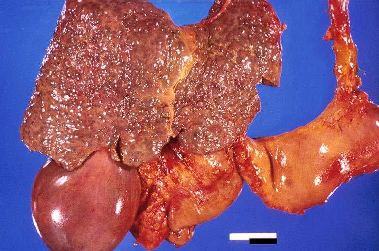 Liver cirrhosis and enlarged gall bladder in Wilson's disease.