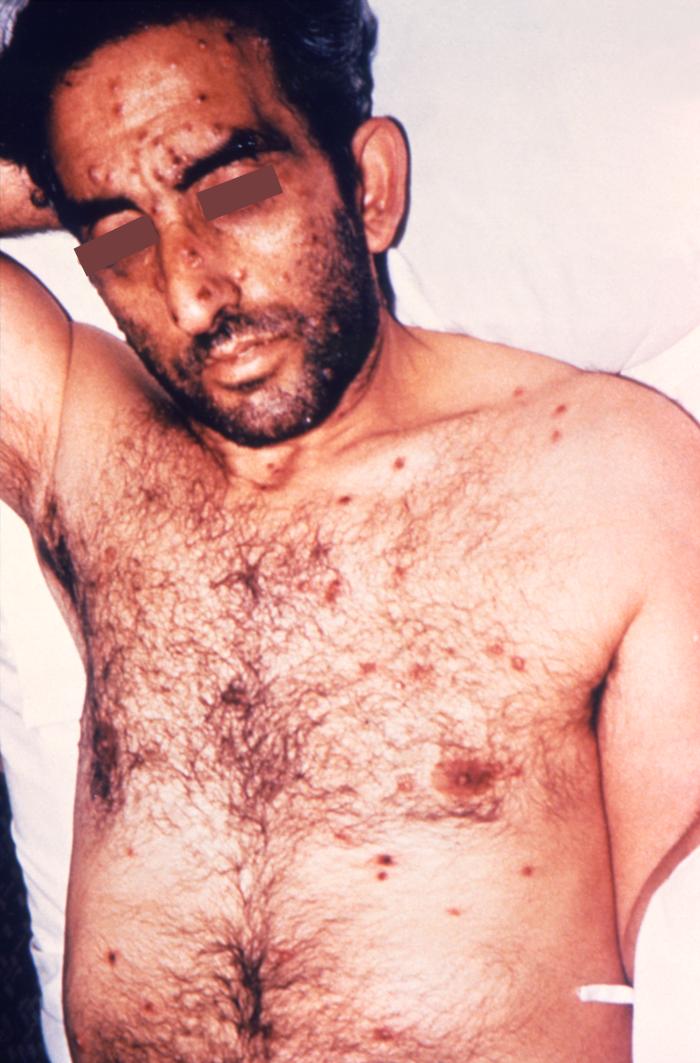The male patient depicted here was in bed, in a clinical setting, and had presented with a pancorporeal maculopapular rash, which was initially thought to be a possible case of smallpox, but which later, was diagnosed as herpes simplex. See PHIL 15819, for another view of this patient in the same setting. Herpes simplex virus, otherwise known as Herpesvirus hominis is a member of a group of viruses including those which cause oral herpes, i.e., usually HSV-1, and genital herpes, i.e., usually HSV-2. The virus can become disseminated, as was the case here, usually involving patients who are immunocompromised such as in the case of AIDS, or undergoing chemotherapeutic treatment. Adapted from CDC