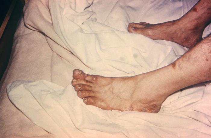 Viewed from the right posterior-oblique view, the male patient depicted here was in bed, in a clinical setting, and had presented with a pancorporeal maculopapular rash, which was initially thought to be a possible case of smallpox, but which later, was diagnosed as herpes simplex. Here you see the patient’s feet from a left lateral perspective revealing papules on the dorsal surface of the left foot. Herpes simplex virus, otherwise known as Herpesvirus hominis is a member of a group of viruses including those which cause oral herpes, i.e., usually HSV-1, and genital herpes, i.e., usually HSV-2. The virus can become disseminated, as was the case here, usually involving patients who are immunocompromised such as in the case of AIDS, or undergoing chemotherapeutic treatment. Adapted from CDC