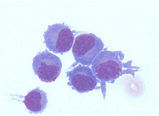 File:Csf plasmacytoid cells.png