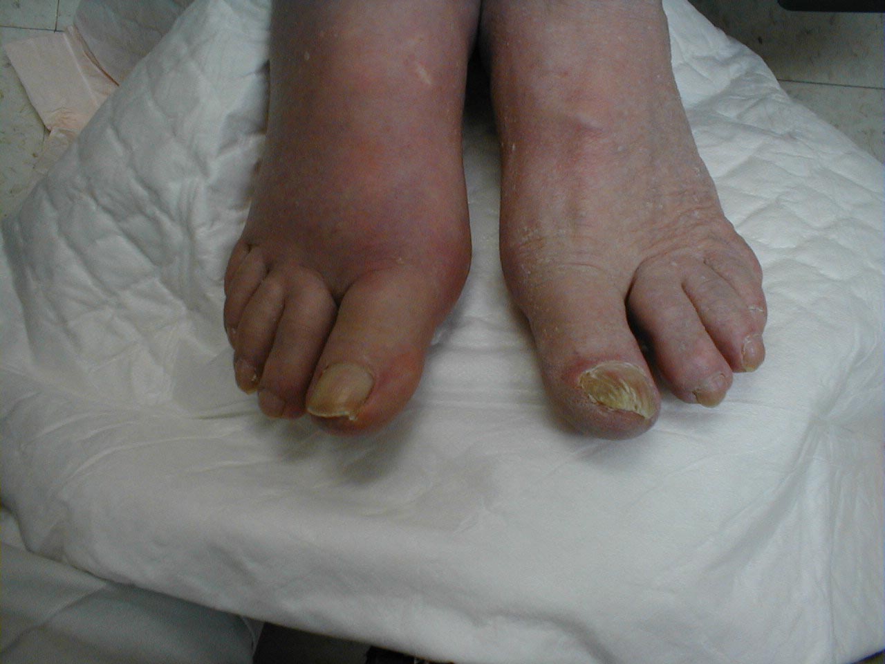 Gout of the Right Great Toe: Diffuse swelling and redness centered at the right MTP joint, but extending over much of the foot.