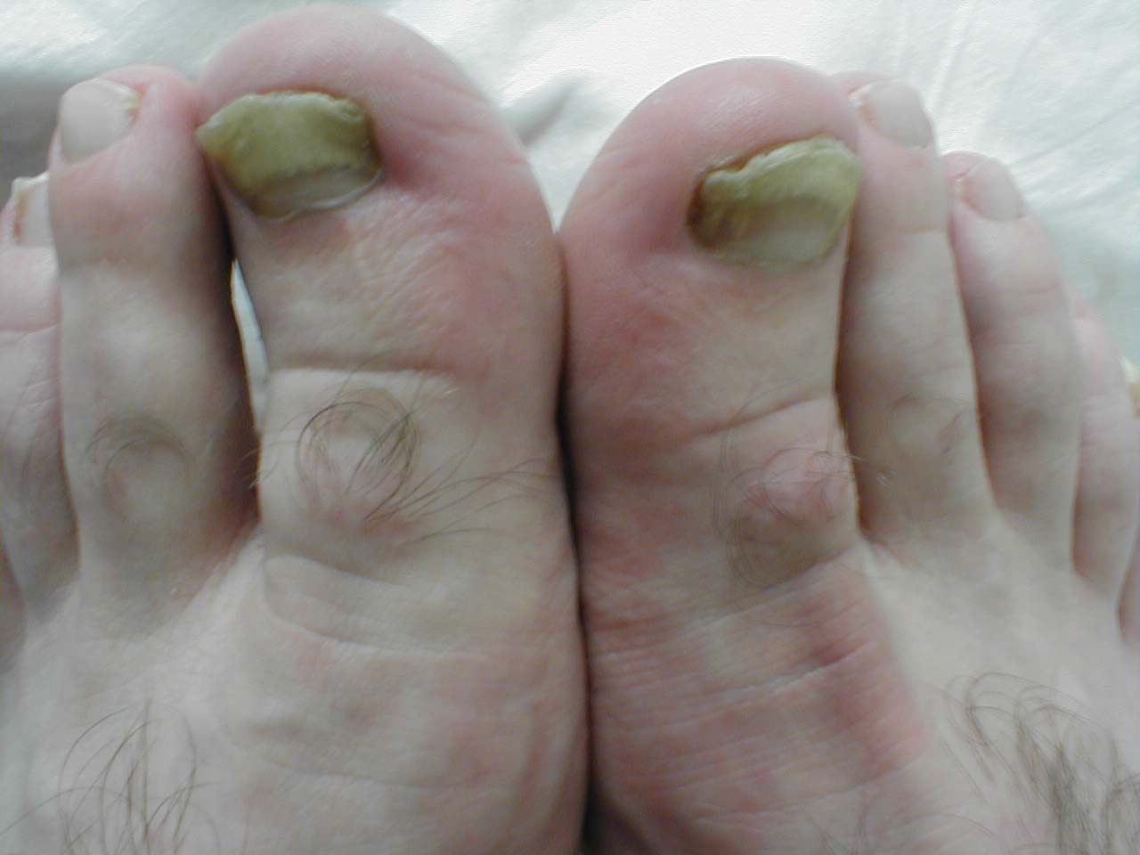 Onychomycosis: Chronic fungal toenail infection causing deformity and discoloration.